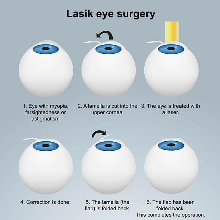 My Lasik Procedure